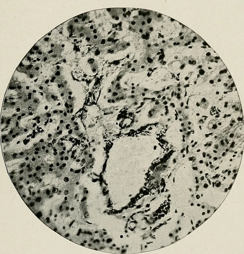 An illustration from Bismuth paste in chronic suppurations : its diagnostic importance and therapeutic value / by Emil G. Beck ... with an introduction by Carl Beck, M. D., and a chapter on the application of bismuth paste in the treatment of chronic suppuration of the nasal accessory sinuses and the ear, by Joseph C. Beck, M. D. With eighty-one engravings, nine diagrammatic illustrations, and a colored plate., 1914, leaf 195