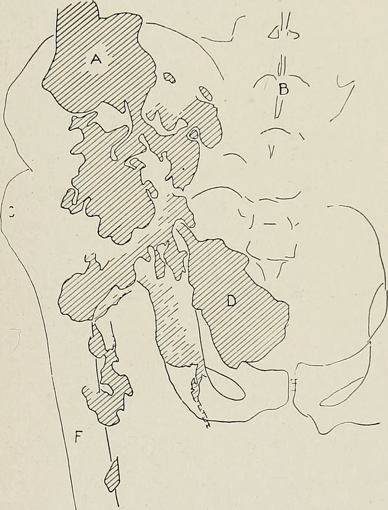 An illustration from Bismuth paste in chronic suppurations : its diagnostic importance and therapeutic value / by Emil G. Beck ... with an introduction by Carl Beck, M. D., and a chapter on the application of bismuth paste in the treatment of chronic suppuration of the nasal accessory sinuses and the ear, by Joseph C. Beck, M. D. With eighty-one engravings, nine diagrammatic illustrations, and a colored plate., 1914, leaf 199