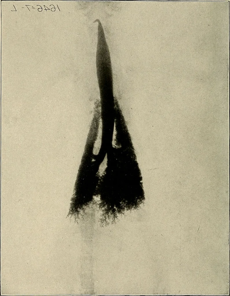 An illustration from Bismuth paste in chronic suppurations : its diagnostic importance and therapeutic value / by Emil G. Beck ... with an introduction by Carl Beck, M. D., and a chapter on the application of bismuth paste in the treatment of chronic suppuration of the nasal accessory sinuses and the ear, by Joseph C. Beck, M. D. With eighty-one engravings, nine diagrammatic illustrations, and a colored plate., 1914, leaf 38