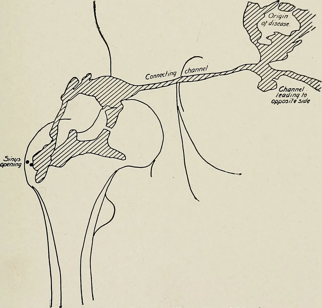 An illustration from Bismuth paste in chronic suppurations : its diagnostic importance and therapeutic value / by Emil G. Beck ... with an introduction by Carl Beck, M. D., and a chapter on the application of bismuth paste in the treatment of chronic suppuration of the nasal accessory sinuses and the ear, by Joseph C. Beck, M. D. With eighty-one engravings, nine diagrammatic illustrations, and a colored plate., 1914, leaf 43