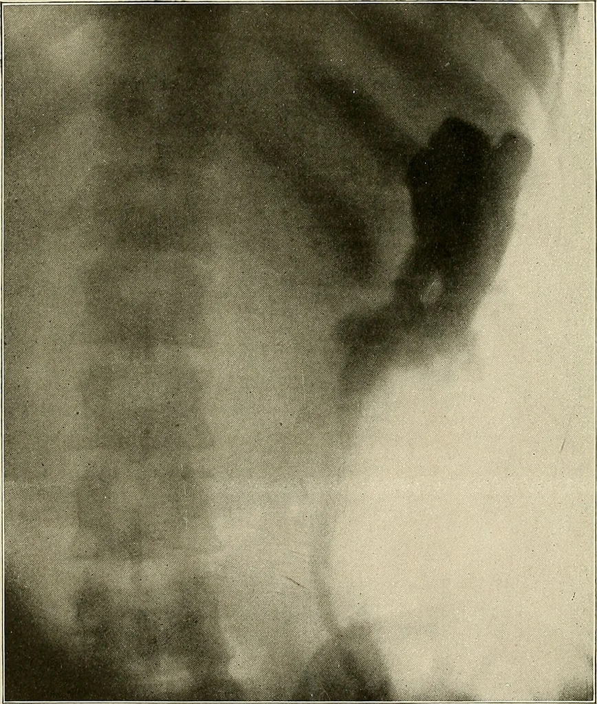 An illustration from Bismuth paste in chronic suppurations : its diagnostic importance and therapeutic value / by Emil G. Beck ... with an introduction by Carl Beck, M. D., and a chapter on the application of bismuth paste in the treatment of chronic suppuration of the nasal accessory sinuses and the ear, by Joseph C. Beck, M. D. With eighty-one engravings, nine diagrammatic illustrations, and a colored plate., 1914, leaf 44