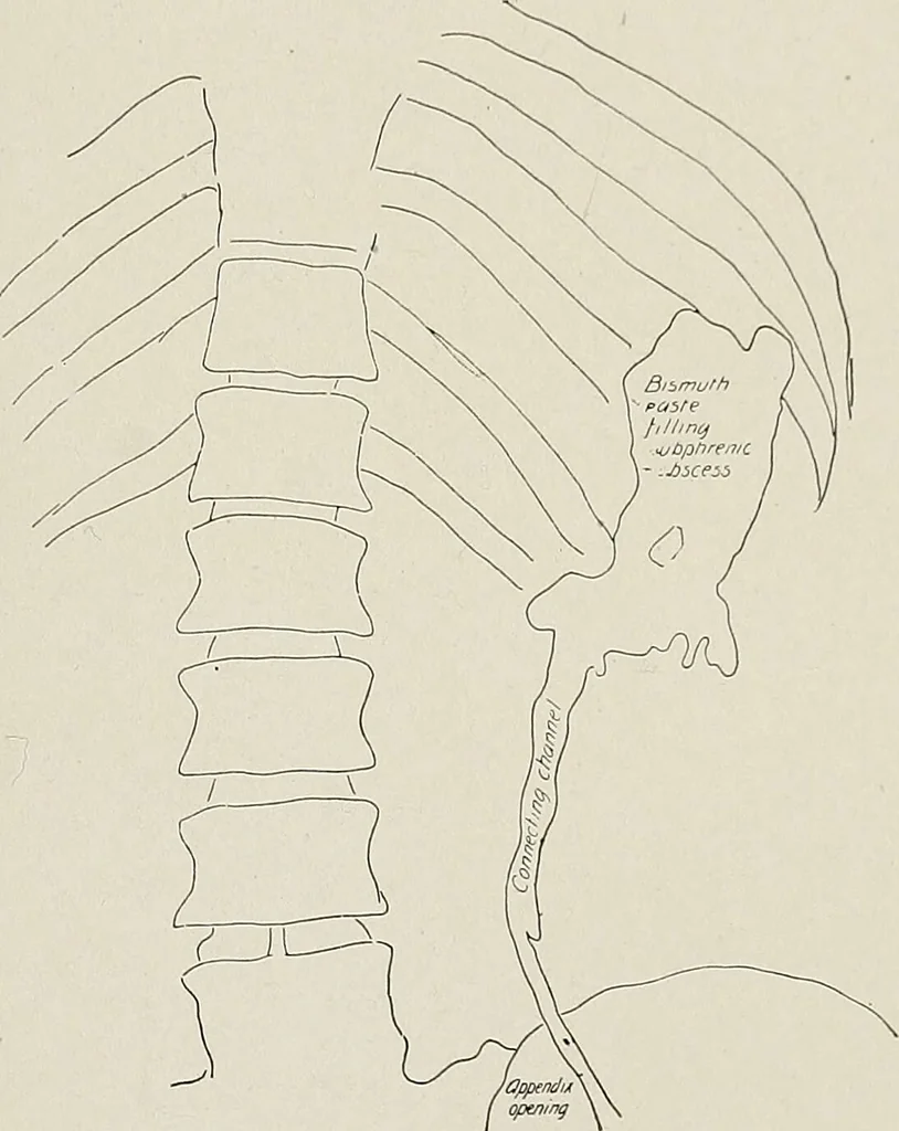 An illustration from Bismuth paste in chronic suppurations : its diagnostic importance and therapeutic value / by Emil G. Beck ... with an introduction by Carl Beck, M. D., and a chapter on the application of bismuth paste in the treatment of chronic suppuration of the nasal accessory sinuses and the ear, by Joseph C. Beck, M. D. With eighty-one engravings, nine diagrammatic illustrations, and a colored plate., 1914, leaf 45