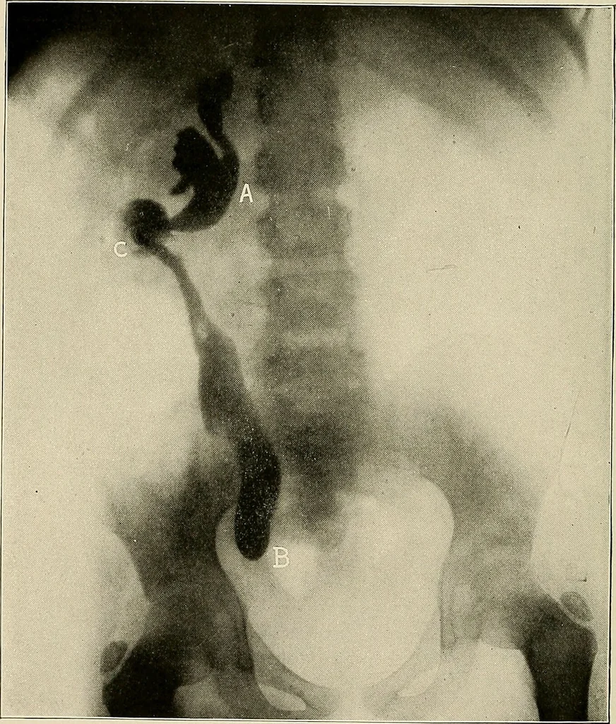 An illustration from Bismuth paste in chronic suppurations : its diagnostic importance and therapeutic value / by Emil G. Beck ... with an introduction by Carl Beck, M. D., and a chapter on the application of bismuth paste in the treatment of chronic suppuration of the nasal accessory sinuses and the ear, by Joseph C. Beck, M. D. With eighty-one engravings, nine diagrammatic illustrations, and a colored plate., 1914, leaf 46