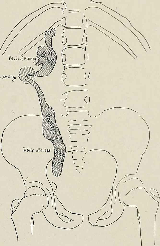 An illustration from Bismuth paste in chronic suppurations : its diagnostic importance and therapeutic value / by Emil G. Beck ... with an introduction by Carl Beck, M. D., and a chapter on the application of bismuth paste in the treatment of chronic suppuration of the nasal accessory sinuses and the ear, by Joseph C. Beck, M. D. With eighty-one engravings, nine diagrammatic illustrations, and a colored plate., 1914, leaf 47