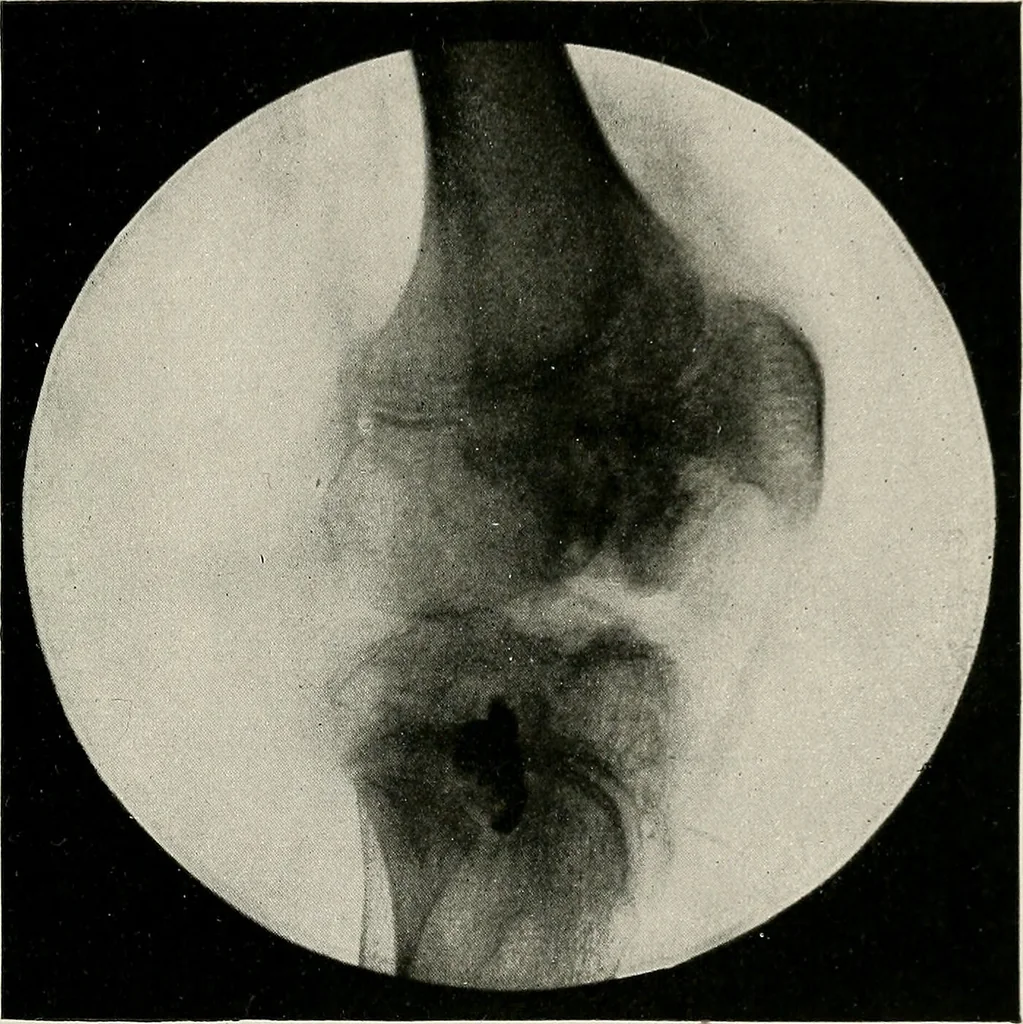 An illustration from Bismuth paste in chronic suppurations : its diagnostic importance and therapeutic value / by Emil G. Beck ... with an introduction by Carl Beck, M. D., and a chapter on the application of bismuth paste in the treatment of chronic suppuration of the nasal accessory sinuses and the ear, by Joseph C. Beck, M. D. With eighty-one engravings, nine diagrammatic illustrations, and a colored plate., 1914, leaf 49