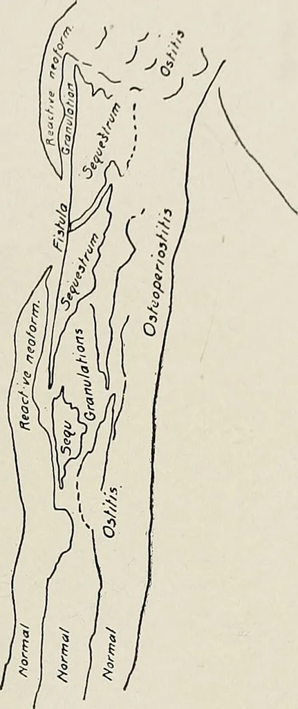 An illustration from Bismuth paste in chronic suppurations : its diagnostic importance and therapeutic value / by Emil G. Beck ... with an introduction by Carl Beck, M. D., and a chapter on the application of bismuth paste in the treatment of chronic suppuration of the nasal accessory sinuses and the ear, by Joseph C. Beck, M. D. With eighty-one engravings, nine diagrammatic illustrations, and a colored plate., 1914, leaf 77