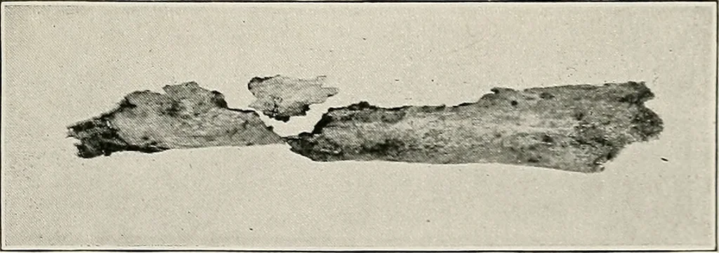 An illustration from Bismuth paste in chronic suppurations : its diagnostic importance and therapeutic value / by Emil G. Beck ... with an introduction by Carl Beck, M. D., and a chapter on the application of bismuth paste in the treatment of chronic suppuration of the nasal accessory sinuses and the ear, by Joseph C. Beck, M. D. With eighty-one engravings, nine diagrammatic illustrations, and a colored plate., 1914, leaf 77