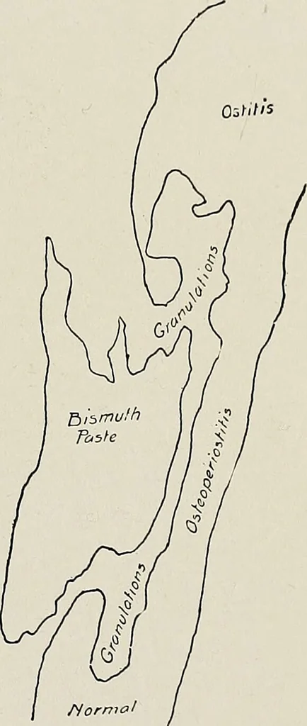 An illustration from Bismuth paste in chronic suppurations : its diagnostic importance and therapeutic value / by Emil G. Beck ... with an introduction by Carl Beck, M. D., and a chapter on the application of bismuth paste in the treatment of chronic suppuration of the nasal accessory sinuses and the ear, by Joseph C. Beck, M. D. With eighty-one engravings, nine diagrammatic illustrations, and a colored plate., 1914, leaf 79
