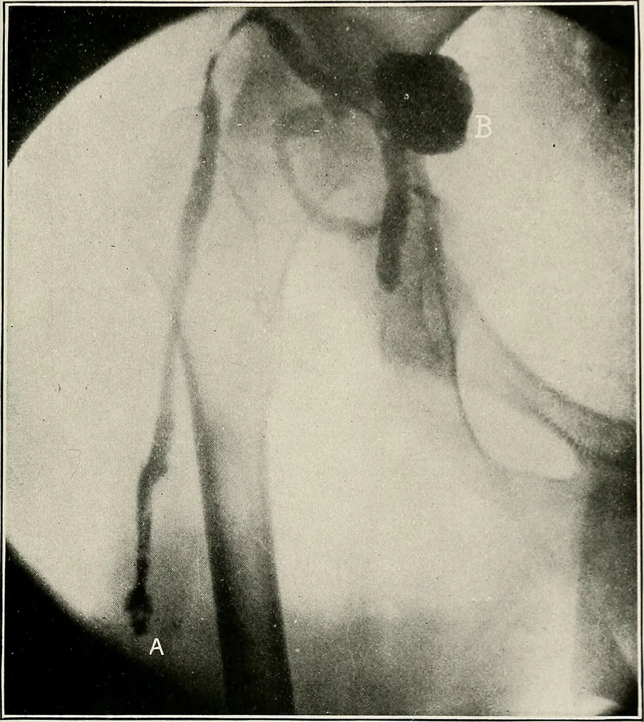 An illustration from Bismuth paste in chronic suppurations : its diagnostic importance and therapeutic value / by Emil G. Beck ... with an introduction by Carl Beck, M. D., and a chapter on the application of bismuth paste in the treatment of chronic suppuration of the nasal accessory sinuses and the ear, by Joseph C. Beck, M. D. With eighty-one engravings, nine diagrammatic illustrations, and a colored plate., 1914, leaf 95
