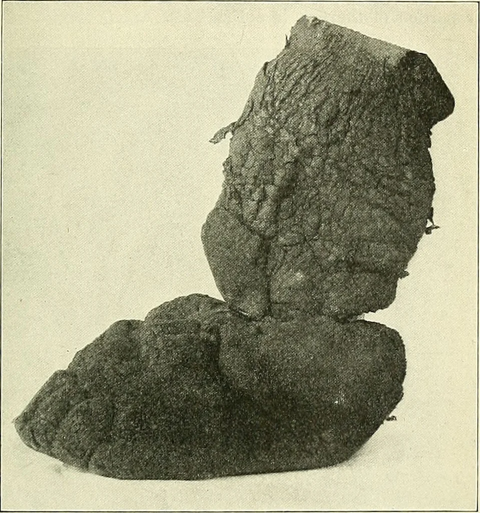 An illustration from An American text-book of genito-urinary diseases, syphilis and diseases of the skin / Ed. by L. Bolton Bangs ... and W. A. Hardaway ... Illustrated with 300 engravings and 20 full-page colored plates., 1898, leaf 1011