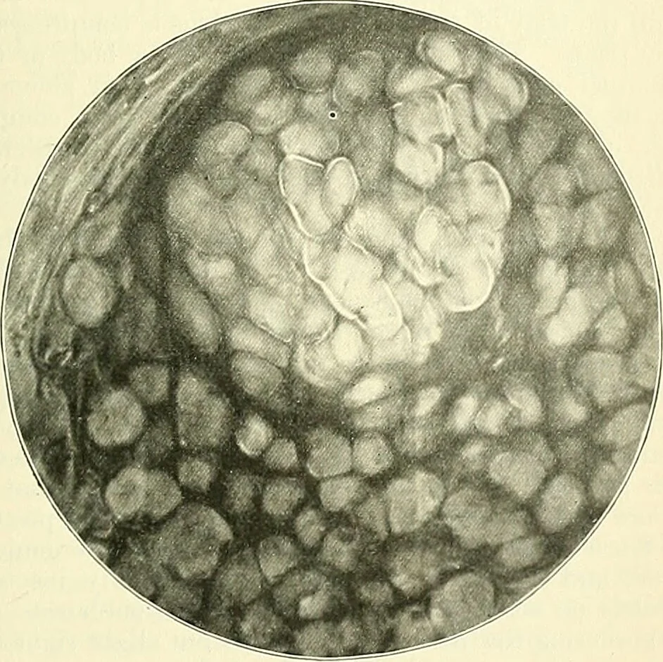 An illustration from An American text-book of genito-urinary diseases, syphilis and diseases of the skin / Ed. by L. Bolton Bangs ... and W. A. Hardaway ... Illustrated with 300 engravings and 20 full-page colored plates., 1898, leaf 1035