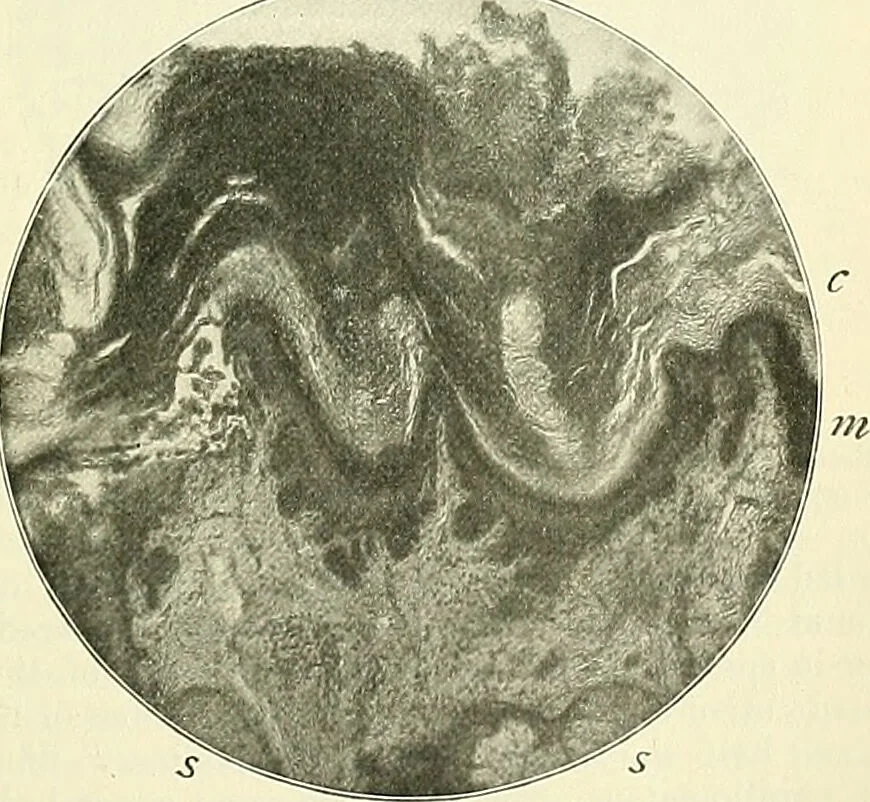 An illustration from An American text-book of genito-urinary diseases, syphilis and diseases of the skin / Ed. by L. Bolton Bangs ... and W. A. Hardaway ... Illustrated with 300 engravings and 20 full-page colored plates., 1898, leaf 1043