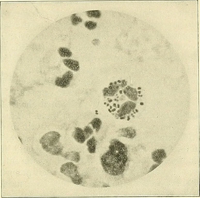 An illustration from An American text-book of genito-urinary diseases, syphilis and diseases of the skin / Ed. by L. Bolton Bangs ... and W. A. Hardaway ... Illustrated with 300 engravings and 20 full-page colored plates., 1898, leaf 105