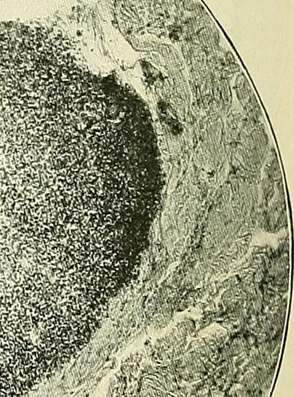 An illustration from An American text-book of genito-urinary diseases, syphilis and diseases of the skin / Ed. by L. Bolton Bangs ... and W. A. Hardaway ... Illustrated with 300 engravings and 20 full-page colored plates., 1898, leaf 1092