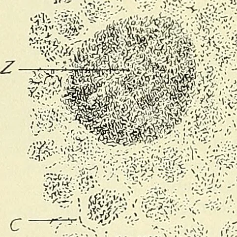 An illustration from An American text-book of genito-urinary diseases, syphilis and diseases of the skin / Ed. by L. Bolton Bangs ... and W. A. Hardaway ... Illustrated with 300 engravings and 20 full-page colored plates., 1898, leaf 1102