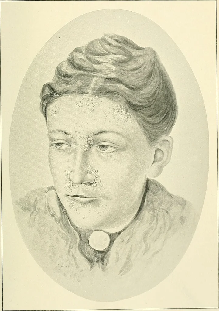 An illustration from An American text-book of genito-urinary diseases, syphilis and diseases of the skin / Ed. by L. Bolton Bangs ... and W. A. Hardaway ... Illustrated with 300 engravings and 20 full-page colored plates., 1898, leaf 1109
