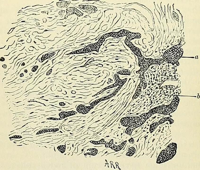 An illustration from An American text-book of genito-urinary diseases, syphilis and diseases of the skin / Ed. by L. Bolton Bangs ... and W. A. Hardaway ... Illustrated with 300 engravings and 20 full-page colored plates., 1898, leaf 1118