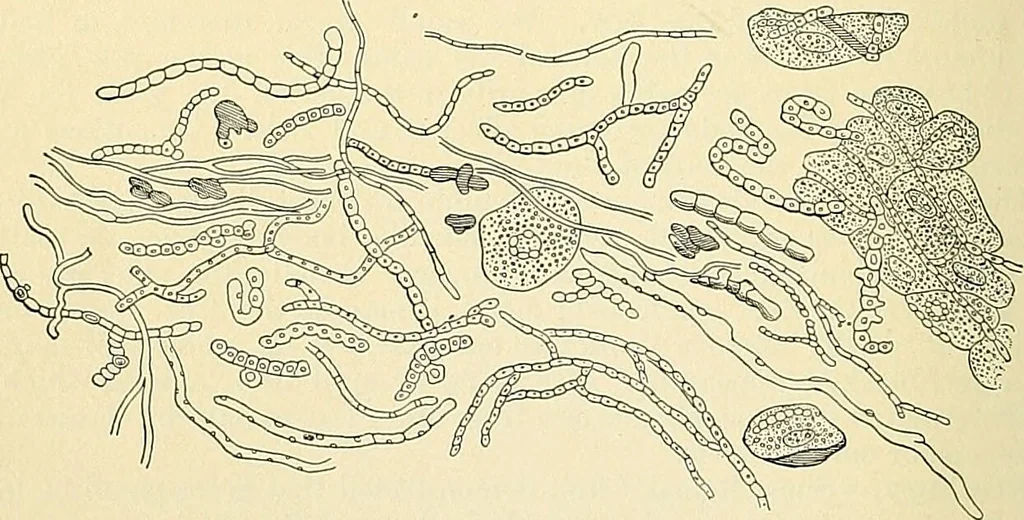 An illustration from An American text-book of genito-urinary diseases, syphilis and diseases of the skin / Ed. by L. Bolton Bangs ... and W. A. Hardaway ... Illustrated with 300 engravings and 20 full-page colored plates., 1898, leaf 1206