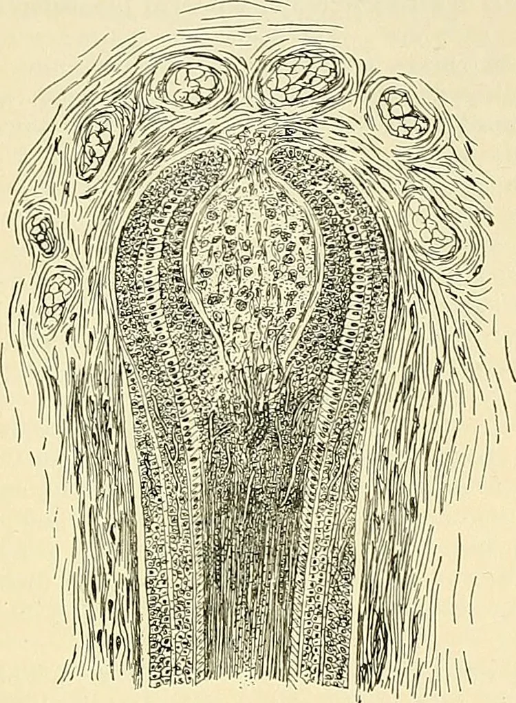 An illustration from An American text-book of genito-urinary diseases, syphilis and diseases of the skin / Ed. by L. Bolton Bangs ... and W. A. Hardaway ... Illustrated with 300 engravings and 20 full-page colored plates., 1898, leaf 1230