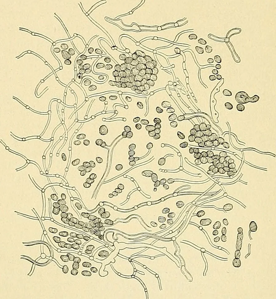 An illustration from An American text-book of genito-urinary diseases, syphilis and diseases of the skin / Ed. by L. Bolton Bangs ... and W. A. Hardaway ... Illustrated with 300 engravings and 20 full-page colored plates., 1898, leaf 1244