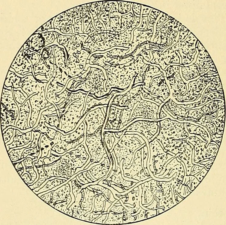 An illustration from An American text-book of genito-urinary diseases, syphilis and diseases of the skin / Ed. by L. Bolton Bangs ... and W. A. Hardaway ... Illustrated with 300 engravings and 20 full-page colored plates., 1898, leaf 1246