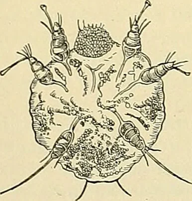 An illustration from An American text-book of genito-urinary diseases, syphilis and diseases of the skin / Ed. by L. Bolton Bangs ... and W. A. Hardaway ... Illustrated with 300 engravings and 20 full-page colored plates., 1898, leaf 1250