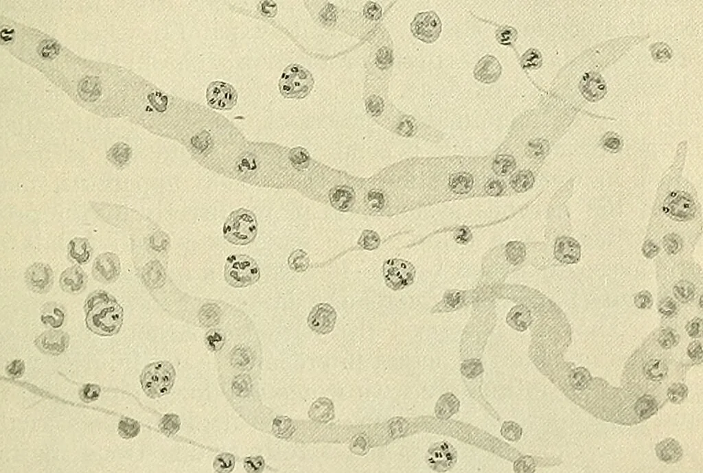 An illustration from An American text-book of genito-urinary diseases, syphilis and diseases of the skin / Ed. by L. Bolton Bangs ... and W. A. Hardaway ... Illustrated with 300 engravings and 20 full-page colored plates., 1898, leaf 133