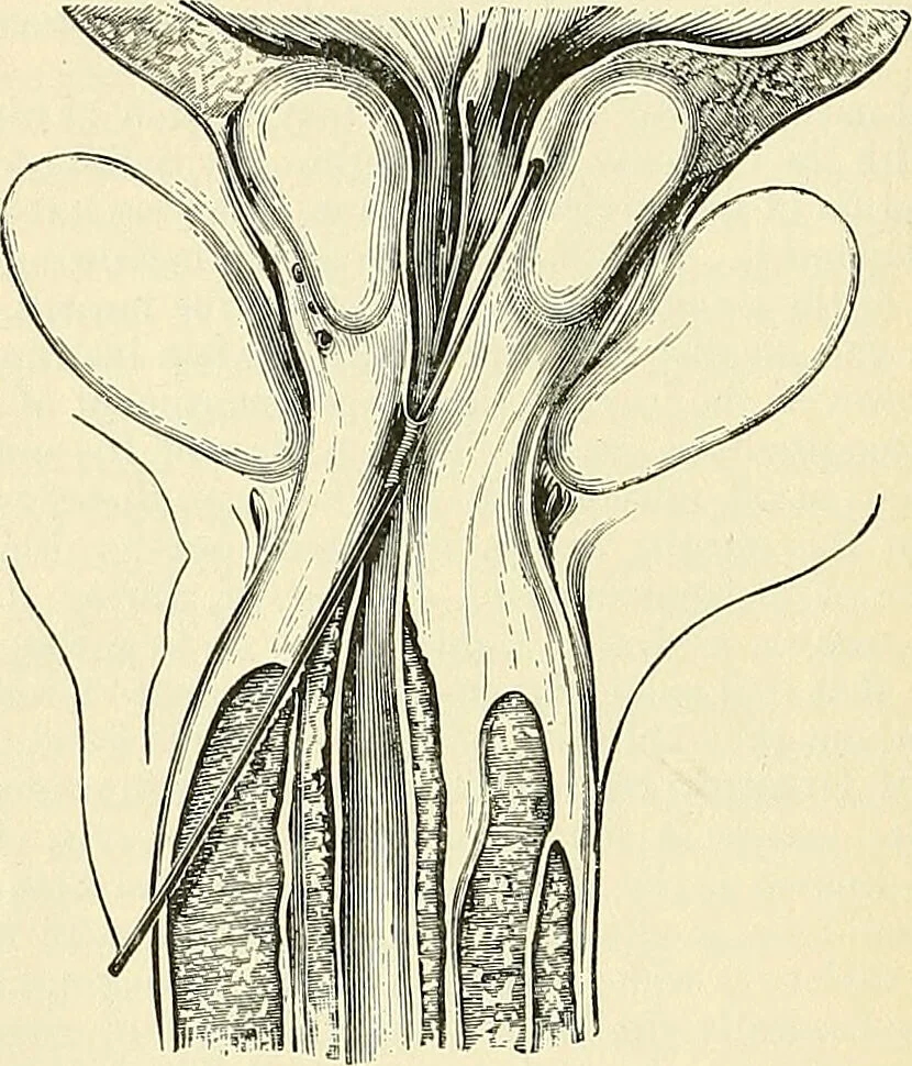 An illustration from An American text-book of genito-urinary diseases, syphilis and diseases of the skin / Ed. by L. Bolton Bangs ... and W. A. Hardaway ... Illustrated with 300 engravings and 20 full-page colored plates., 1898, leaf 154