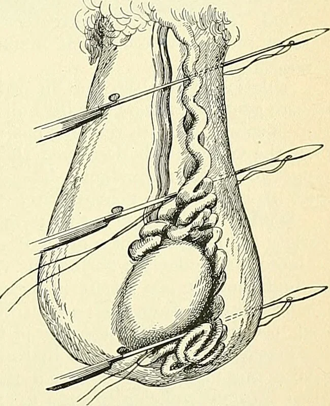 An illustration from An American text-book of genito-urinary diseases, syphilis and diseases of the skin / Ed. by L. Bolton Bangs ... and W. A. Hardaway ... Illustrated with 300 engravings and 20 full-page colored plates., 1898, leaf 231