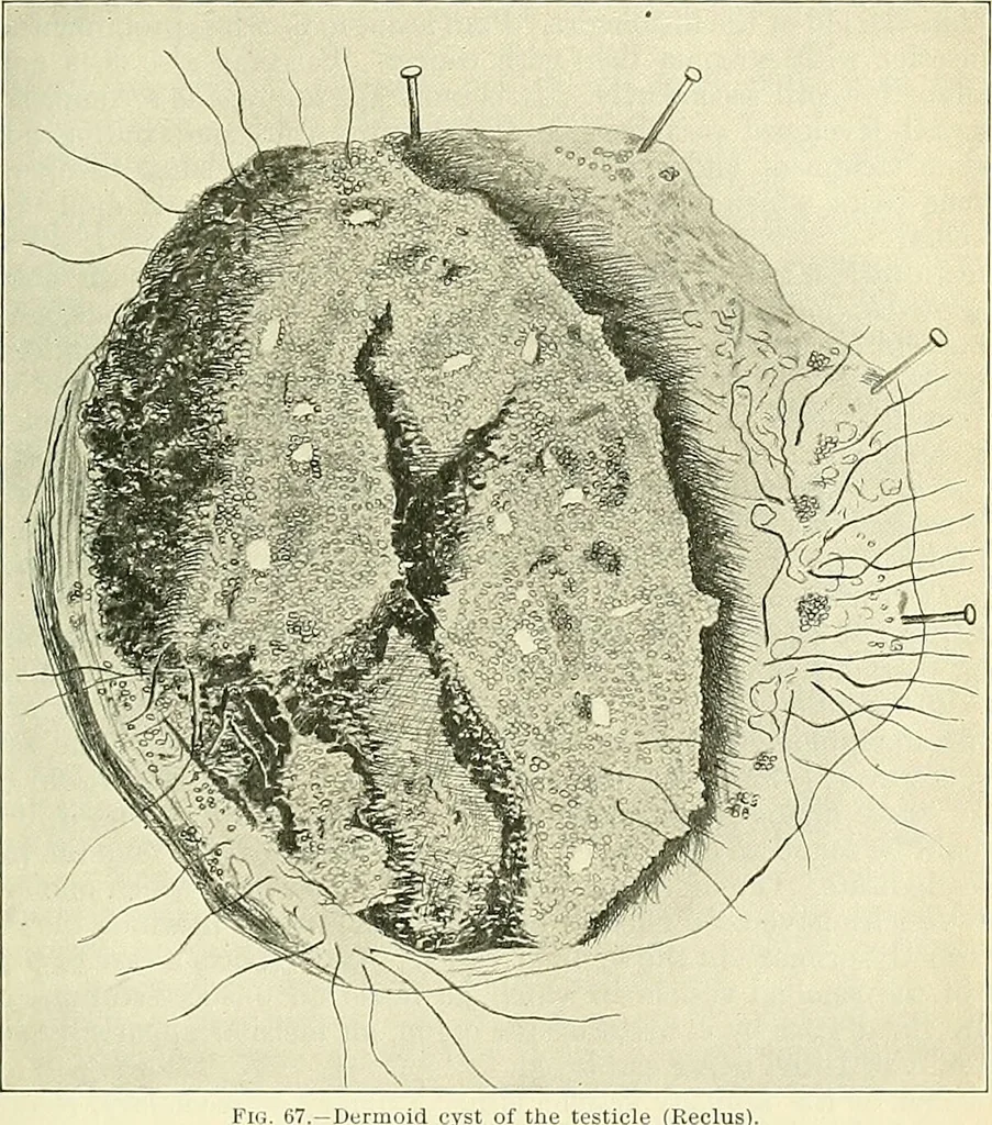 An illustration from An American text-book of genito-urinary diseases, syphilis and diseases of the skin / Ed. by L. Bolton Bangs ... and W. A. Hardaway ... Illustrated with 300 engravings and 20 full-page colored plates., 1898, leaf 263