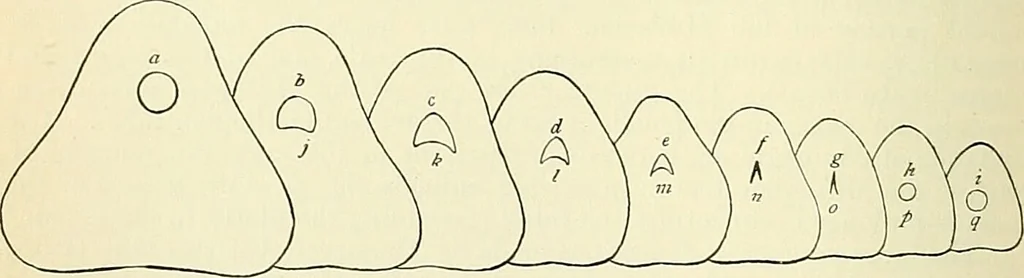 An illustration from An American text-book of genito-urinary diseases, syphilis and diseases of the skin / Ed. by L. Bolton Bangs ... and W. A. Hardaway ... Illustrated with 300 engravings and 20 full-page colored plates., 1898, leaf 266
