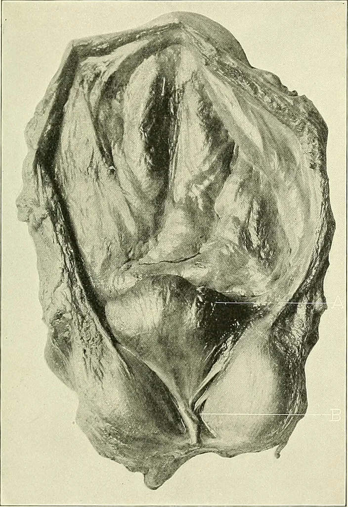 An illustration from An American text-book of genito-urinary diseases, syphilis and diseases of the skin / Ed. by L. Bolton Bangs ... and W. A. Hardaway ... Illustrated with 300 engravings and 20 full-page colored plates., 1898, leaf 283