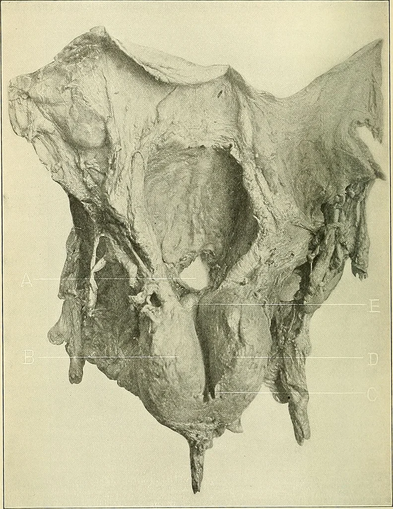 An illustration from An American text-book of genito-urinary diseases, syphilis and diseases of the skin / Ed. by L. Bolton Bangs ... and W. A. Hardaway ... Illustrated with 300 engravings and 20 full-page colored plates., 1898, leaf 284