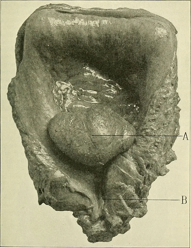 An illustration from An American text-book of genito-urinary diseases, syphilis and diseases of the skin / Ed. by L. Bolton Bangs ... and W. A. Hardaway ... Illustrated with 300 engravings and 20 full-page colored plates., 1898, leaf 289