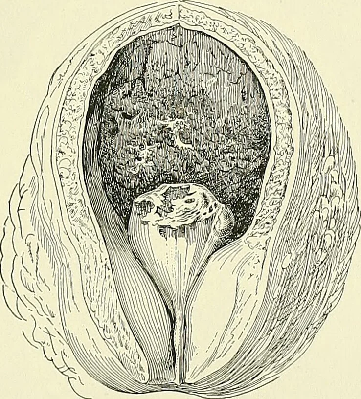 An illustration from An American text-book of genito-urinary diseases, syphilis and diseases of the skin / Ed. by L. Bolton Bangs ... and W. A. Hardaway ... Illustrated with 300 engravings and 20 full-page colored plates., 1898, leaf 361