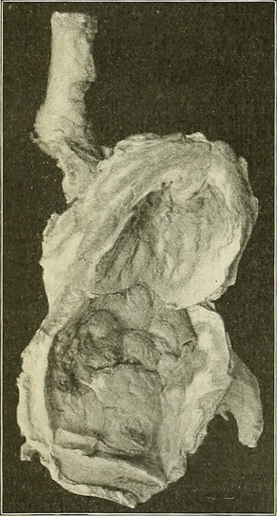 An illustration from An American text-book of genito-urinary diseases, syphilis and diseases of the skin / Ed. by L. Bolton Bangs ... and W. A. Hardaway ... Illustrated with 300 engravings and 20 full-page colored plates., 1898, leaf 366