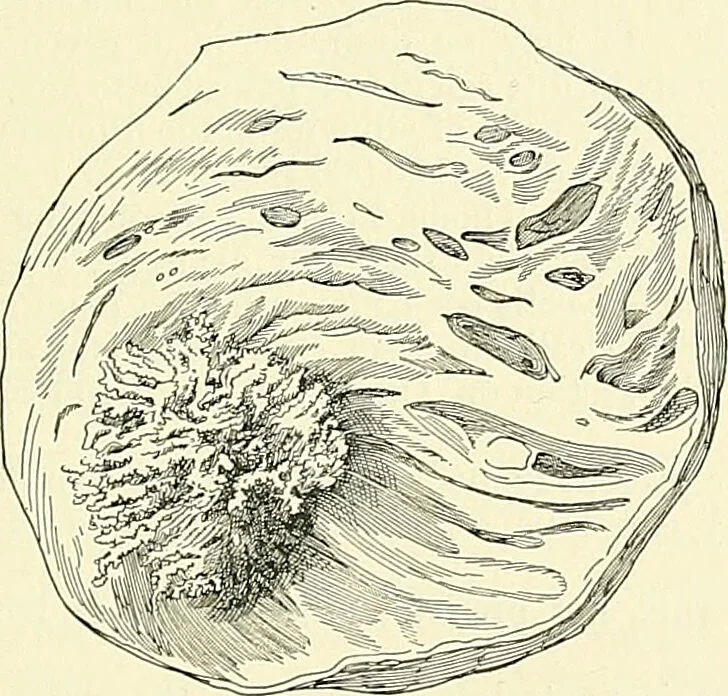 An illustration from An American text-book of genito-urinary diseases, syphilis and diseases of the skin / Ed. by L. Bolton Bangs ... and W. A. Hardaway ... Illustrated with 300 engravings and 20 full-page colored plates., 1898, leaf 367