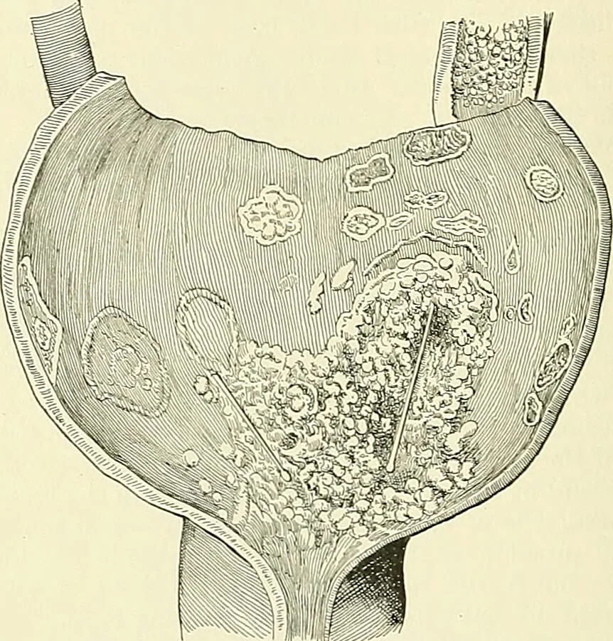 An illustration from An American text-book of genito-urinary diseases, syphilis and diseases of the skin / Ed. by L. Bolton Bangs ... and W. A. Hardaway ... Illustrated with 300 engravings and 20 full-page colored plates., 1898, leaf 384