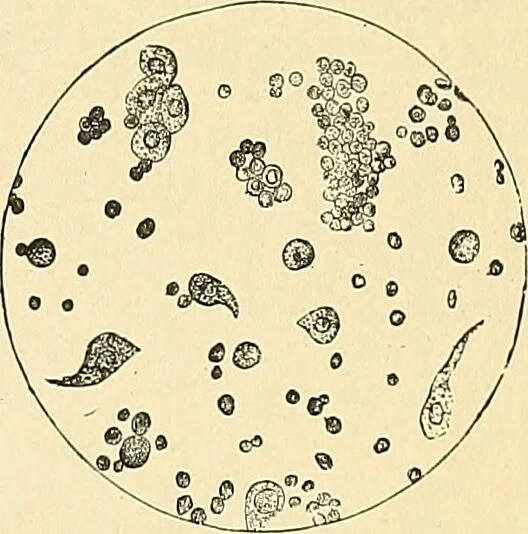 An illustration from An American text-book of genito-urinary diseases, syphilis and diseases of the skin / Ed. by L. Bolton Bangs ... and W. A. Hardaway ... Illustrated with 300 engravings and 20 full-page colored plates., 1898, leaf 39