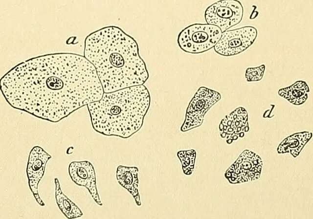 An illustration from An American text-book of genito-urinary diseases, syphilis and diseases of the skin / Ed. by L. Bolton Bangs ... and W. A. Hardaway ... Illustrated with 300 engravings and 20 full-page colored plates., 1898, leaf 39