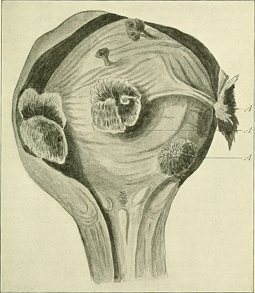 An illustration from An American text-book of genito-urinary diseases, syphilis and diseases of the skin / Ed. by L. Bolton Bangs ... and W. A. Hardaway ... Illustrated with 300 engravings and 20 full-page colored plates., 1898, leaf 391