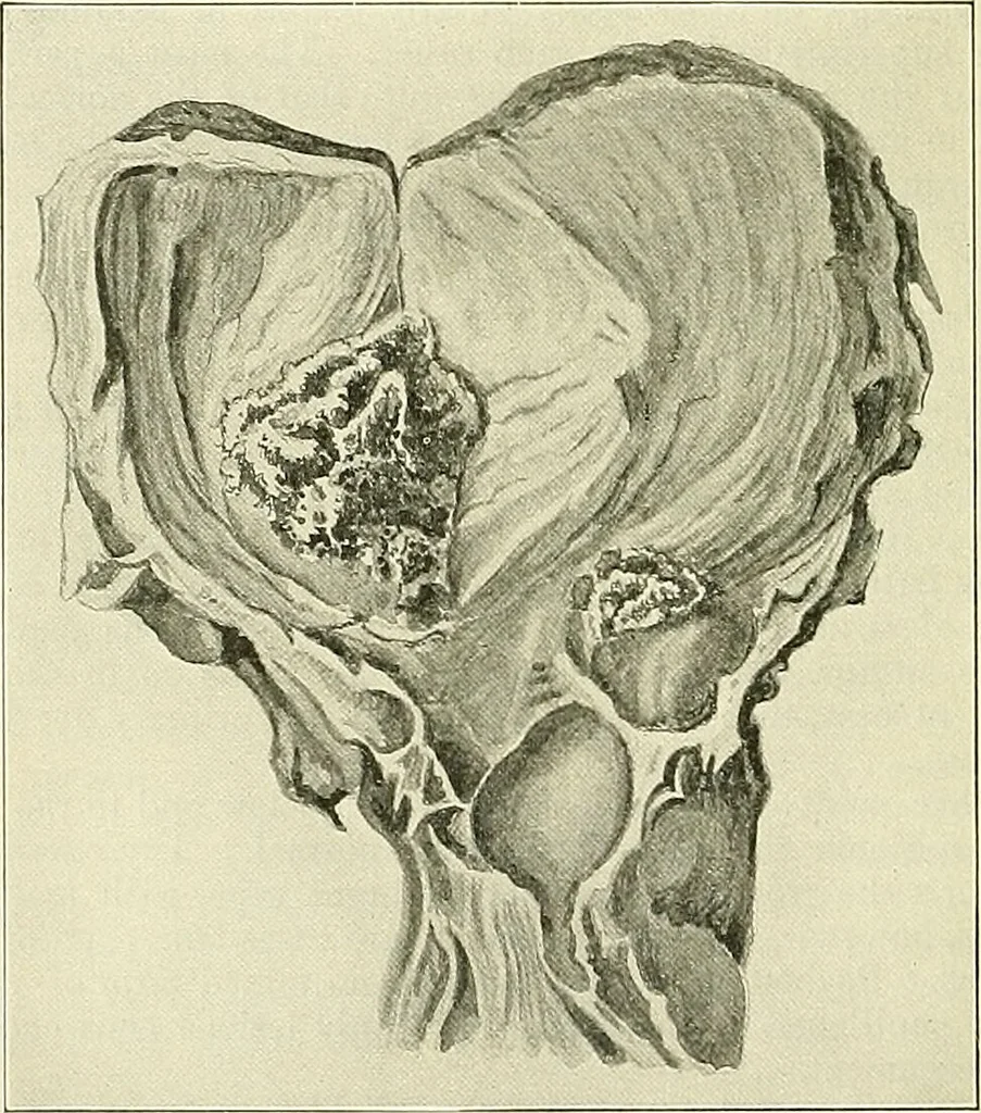 An illustration from An American text-book of genito-urinary diseases, syphilis and diseases of the skin / Ed. by L. Bolton Bangs ... and W. A. Hardaway ... Illustrated with 300 engravings and 20 full-page colored plates., 1898, leaf 394
