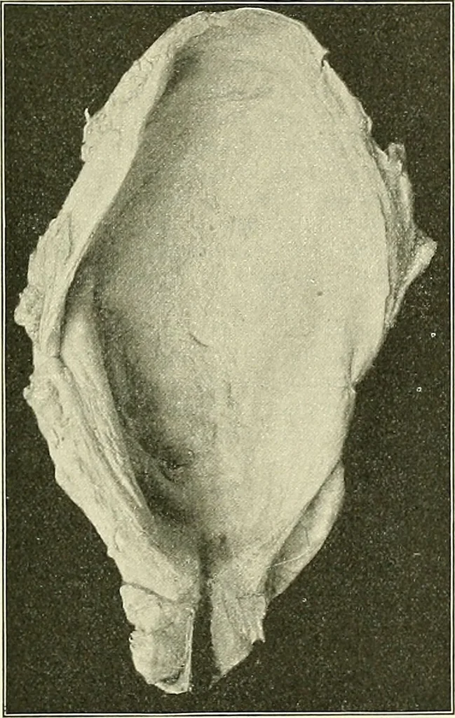 An illustration from An American text-book of genito-urinary diseases, syphilis and diseases of the skin / Ed. by L. Bolton Bangs ... and W. A. Hardaway ... Illustrated with 300 engravings and 20 full-page colored plates., 1898, leaf 409