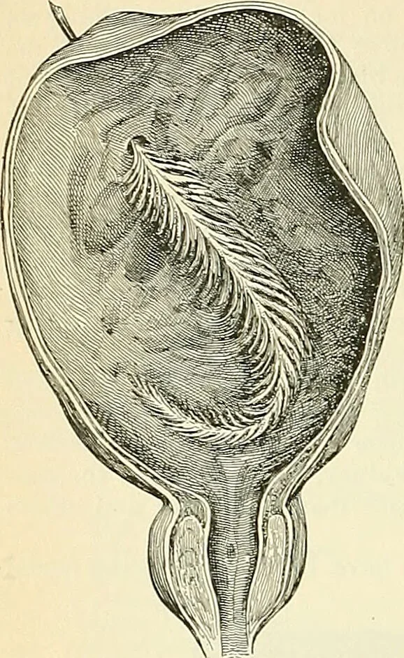 An illustration from An American text-book of genito-urinary diseases, syphilis and diseases of the skin / Ed. by L. Bolton Bangs ... and W. A. Hardaway ... Illustrated with 300 engravings and 20 full-page colored plates., 1898, leaf 430
