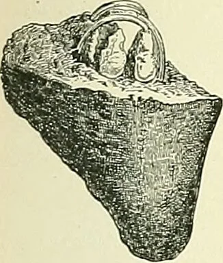 An illustration from An American text-book of genito-urinary diseases, syphilis and diseases of the skin / Ed. by L. Bolton Bangs ... and W. A. Hardaway ... Illustrated with 300 engravings and 20 full-page colored plates., 1898, leaf 431