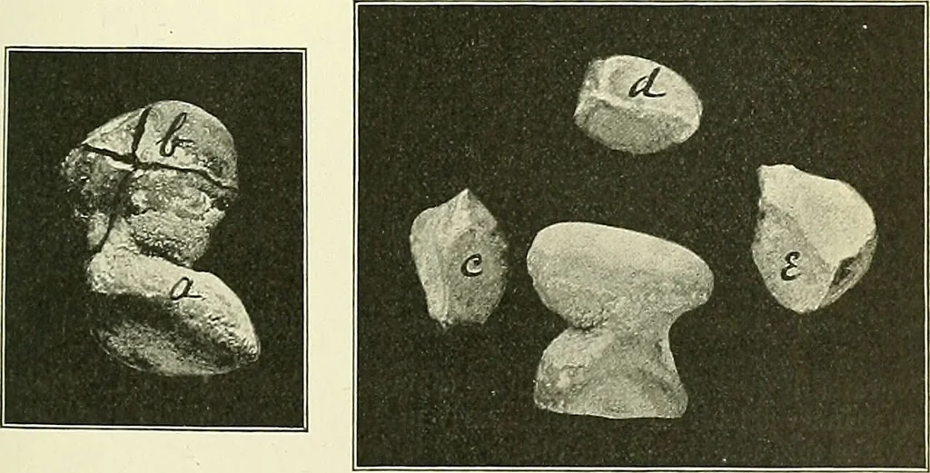An illustration from An American text-book of genito-urinary diseases, syphilis and diseases of the skin / Ed. by L. Bolton Bangs ... and W. A. Hardaway ... Illustrated with 300 engravings and 20 full-page colored plates., 1898, leaf 431