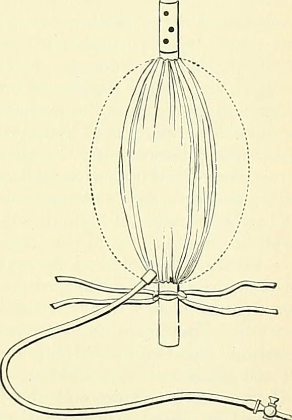 An illustration from An American text-book of genito-urinary diseases, syphilis and diseases of the skin / Ed. by L. Bolton Bangs ... and W. A. Hardaway ... Illustrated with 300 engravings and 20 full-page colored plates., 1898, leaf 455