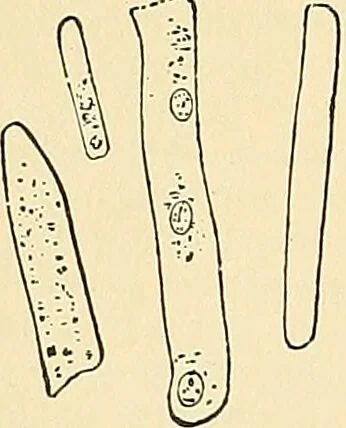 An illustration from An American text-book of genito-urinary diseases, syphilis and diseases of the skin / Ed. by L. Bolton Bangs ... and W. A. Hardaway ... Illustrated with 300 engravings and 20 full-page colored plates., 1898, leaf 46