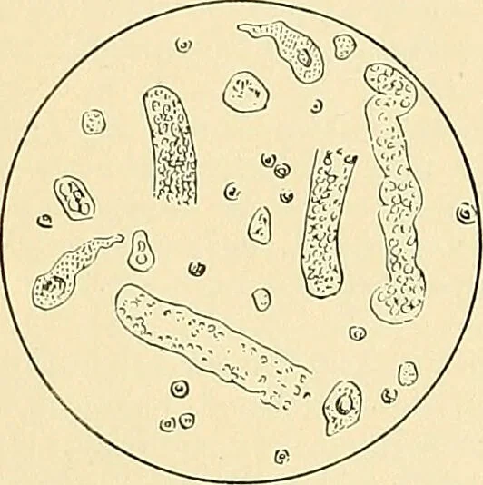 An illustration from An American text-book of genito-urinary diseases, syphilis and diseases of the skin / Ed. by L. Bolton Bangs ... and W. A. Hardaway ... Illustrated with 300 engravings and 20 full-page colored plates., 1898, leaf 46