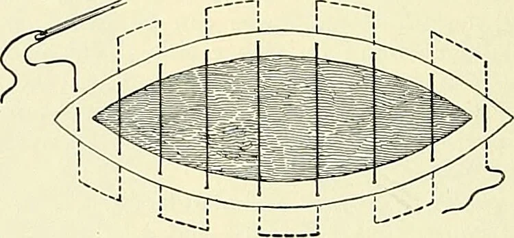 An illustration from An American text-book of genito-urinary diseases, syphilis and diseases of the skin / Ed. by L. Bolton Bangs ... and W. A. Hardaway ... Illustrated with 300 engravings and 20 full-page colored plates., 1898, leaf 460